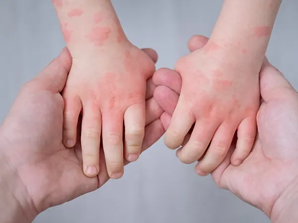 Eczema